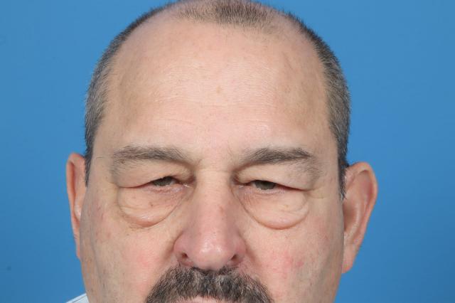 Blepharoplasty before at Plastic Surgery Associates in Grand Rapids, MI
