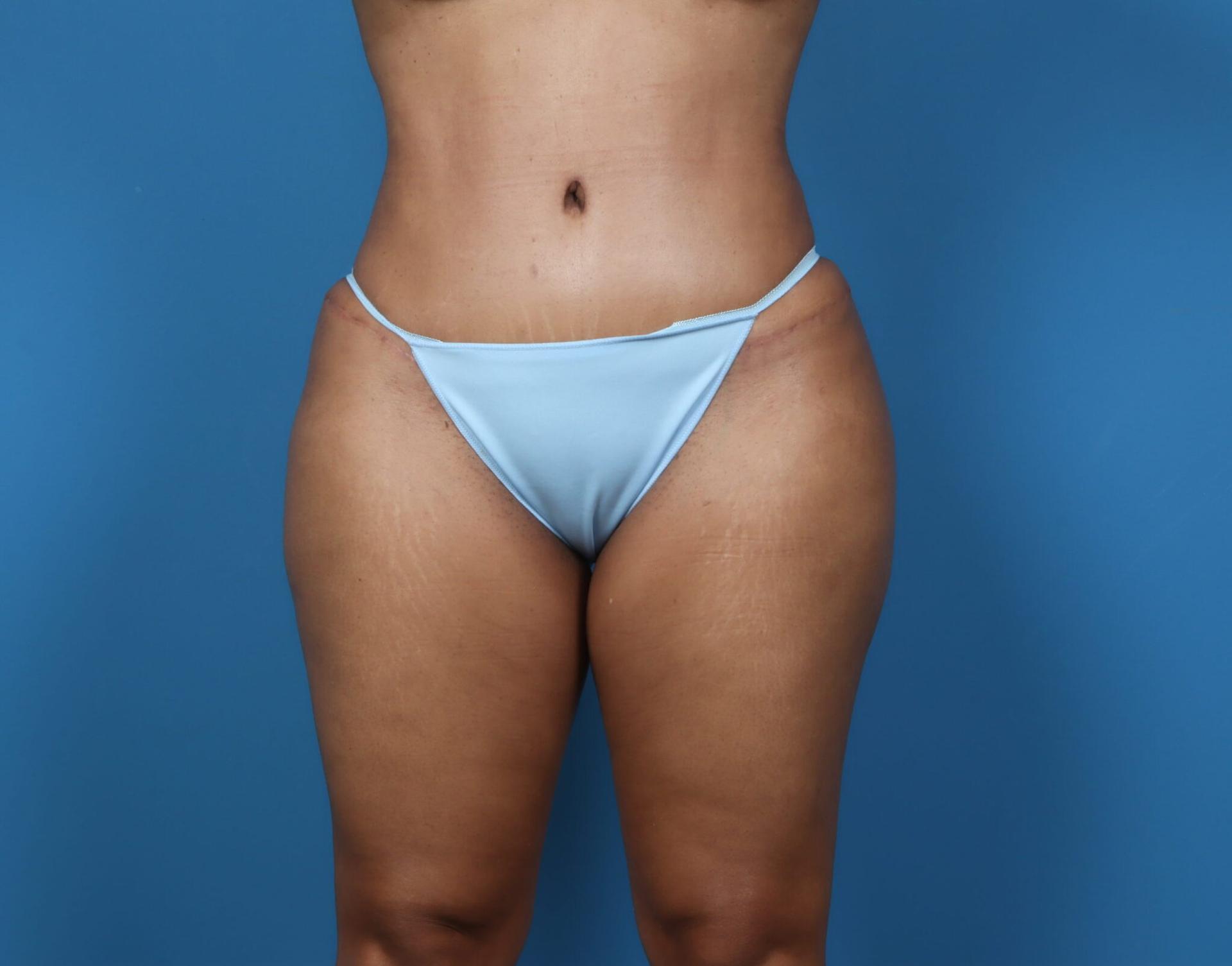Plastic Surgery Associates tummy tuck after — Grand Rapids, MI
