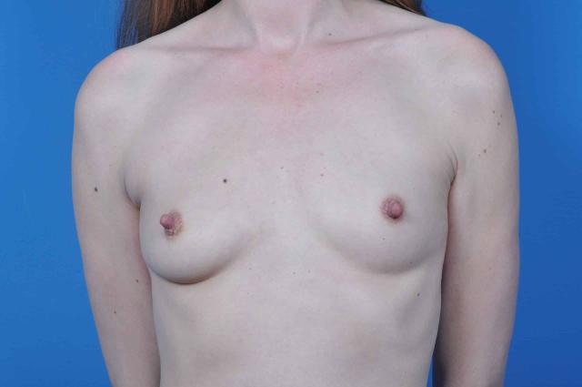 Breast Lift before at Plastic Surgery Associates in Grand Rapids, MI