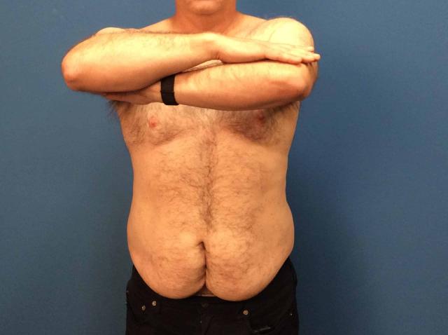 Tummy Tuck before at Plastic Surgery Associates in Grand Rapids, MI