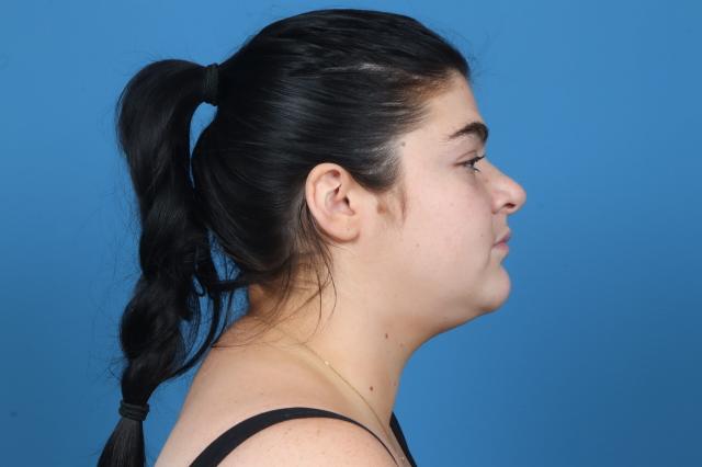 Liposuction before at Plastic Surgery Associates in Grand Rapids, MI