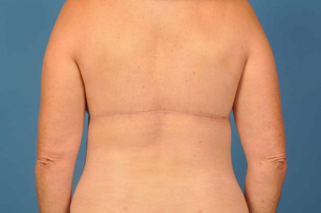 CoolSculpting after at Plastic Surgery Associates in Grand Rapids, MI