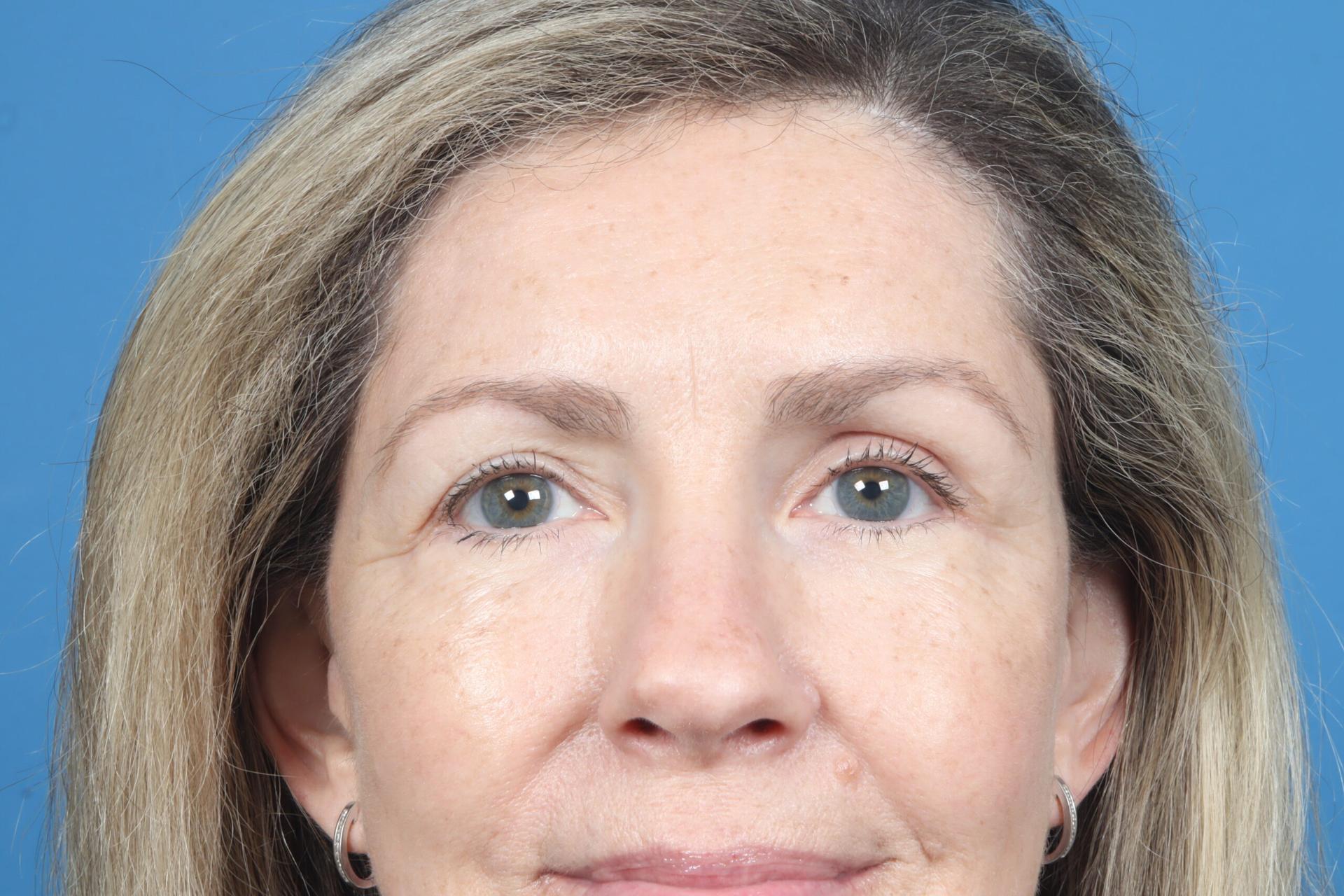 Plastic Surgery Associates brow lift after — Grand Rapids, MI