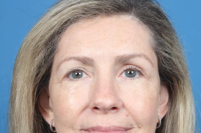 Brow Lift after at Plastic Surgery Associates in Grand Rapids, MI