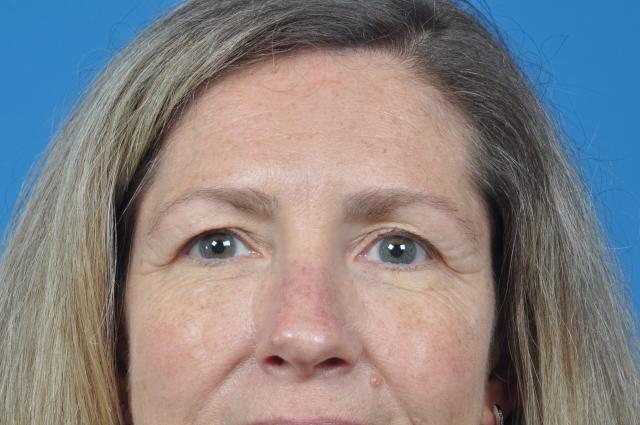 Brow Lift before at Plastic Surgery Associates in Grand Rapids, MI