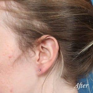 Plastic Surgery Associates after — Grand Rapids, MI