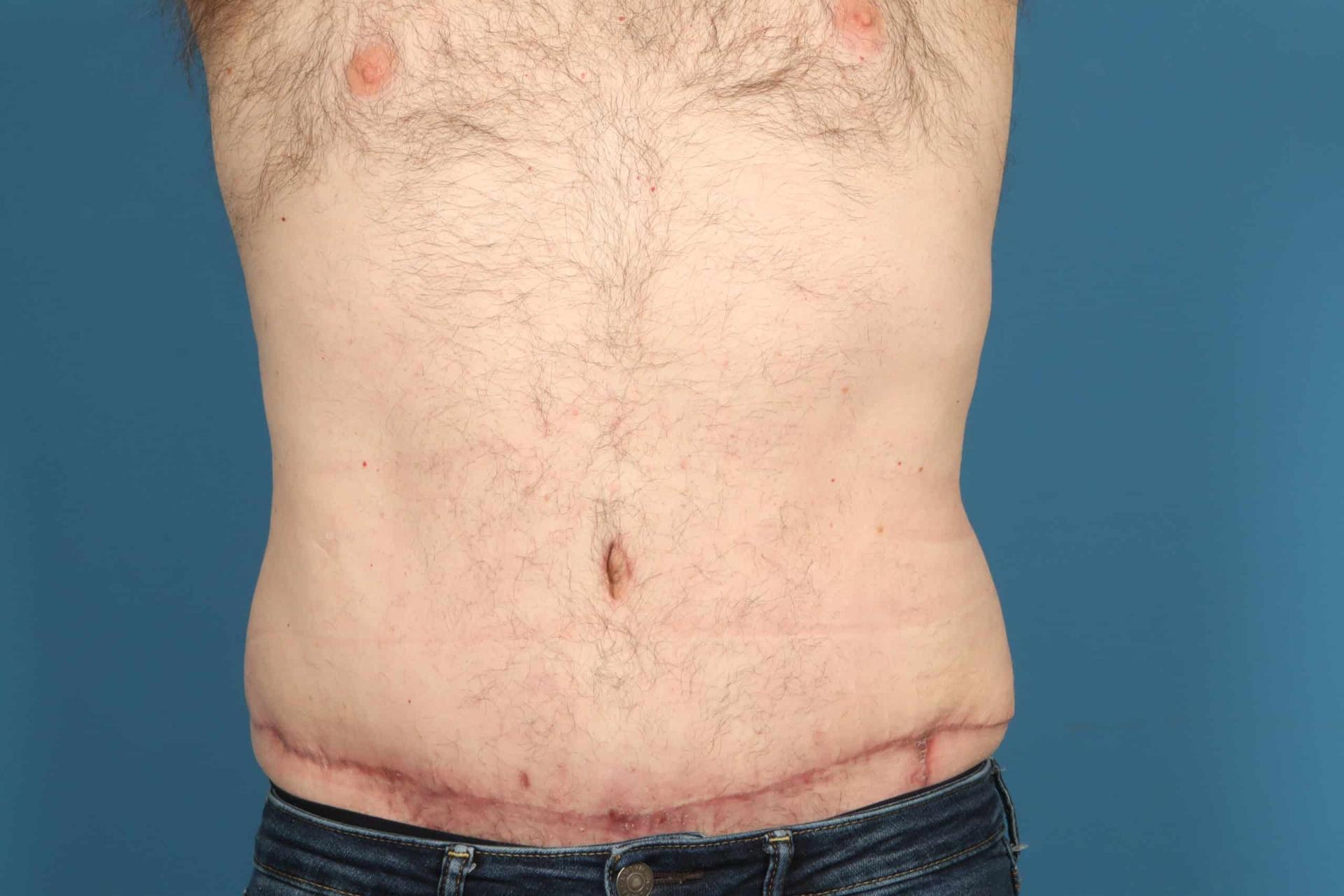 Plastic Surgery Associates tummy tuck after — Grand Rapids, MI