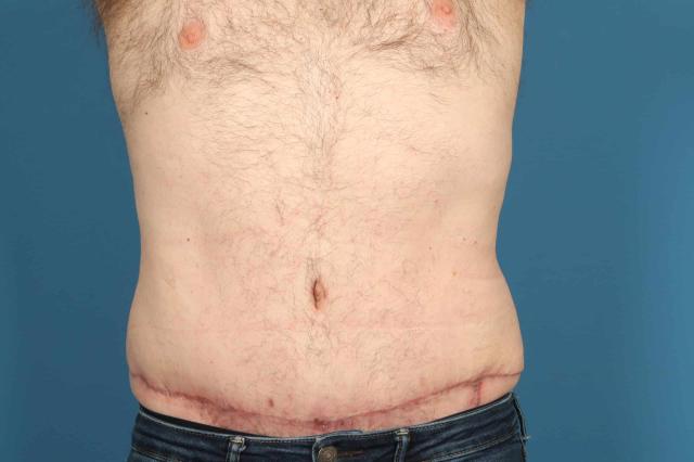 Tummy Tuck after at Plastic Surgery Associates in Grand Rapids, MI