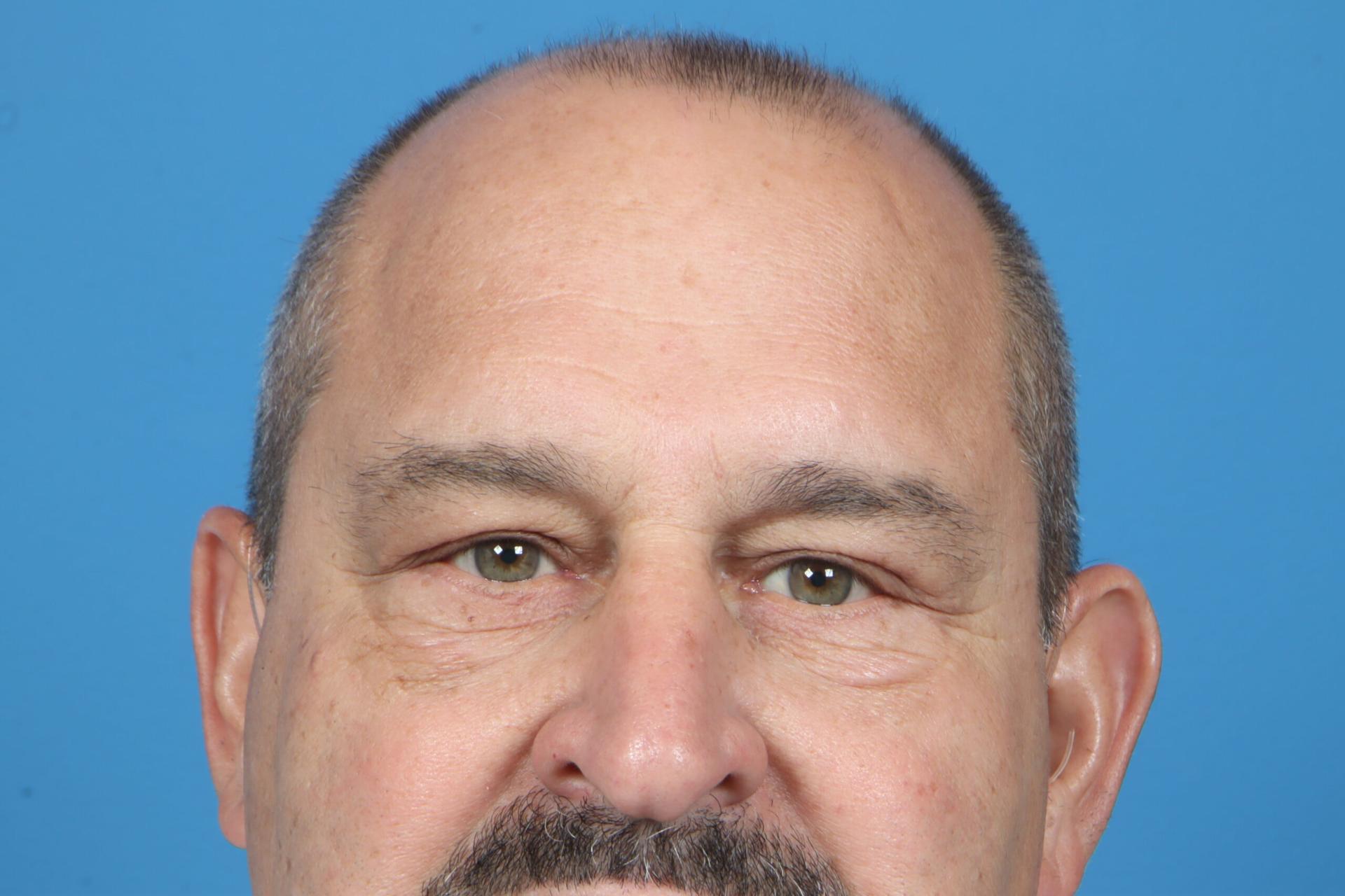 Plastic Surgery Associates eyelid lift after — Grand Rapids, MI