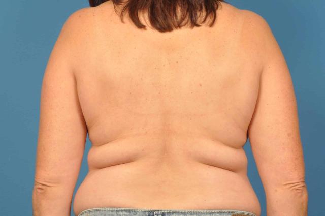 CoolSculpting before at Plastic Surgery Associates in Grand Rapids, MI