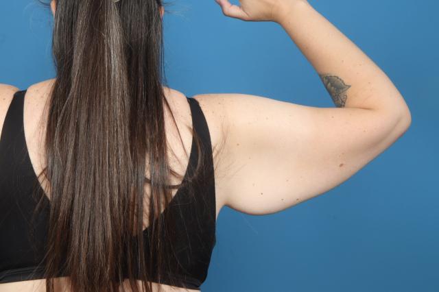 Brazilian Butt Lift before at Plastic Surgery Associates in Grand Rapids, MI