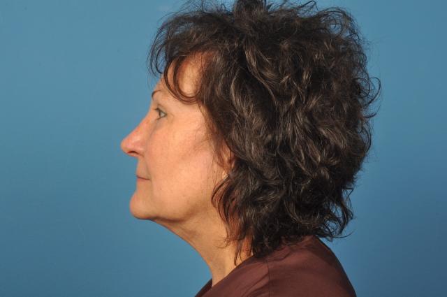 Liposuction after at Plastic Surgery Associates in Grand Rapids, MI