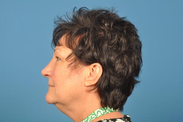 Liposuction before at Plastic Surgery Associates in Grand Rapids, MI