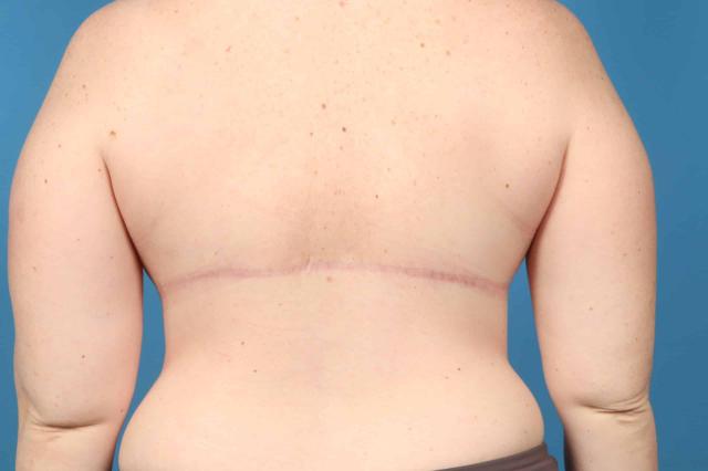 Thigh Lift after at Plastic Surgery Associates in Grand Rapids, MI