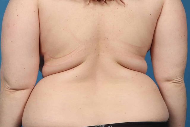 Thigh Lift before at Plastic Surgery Associates in Grand Rapids, MI