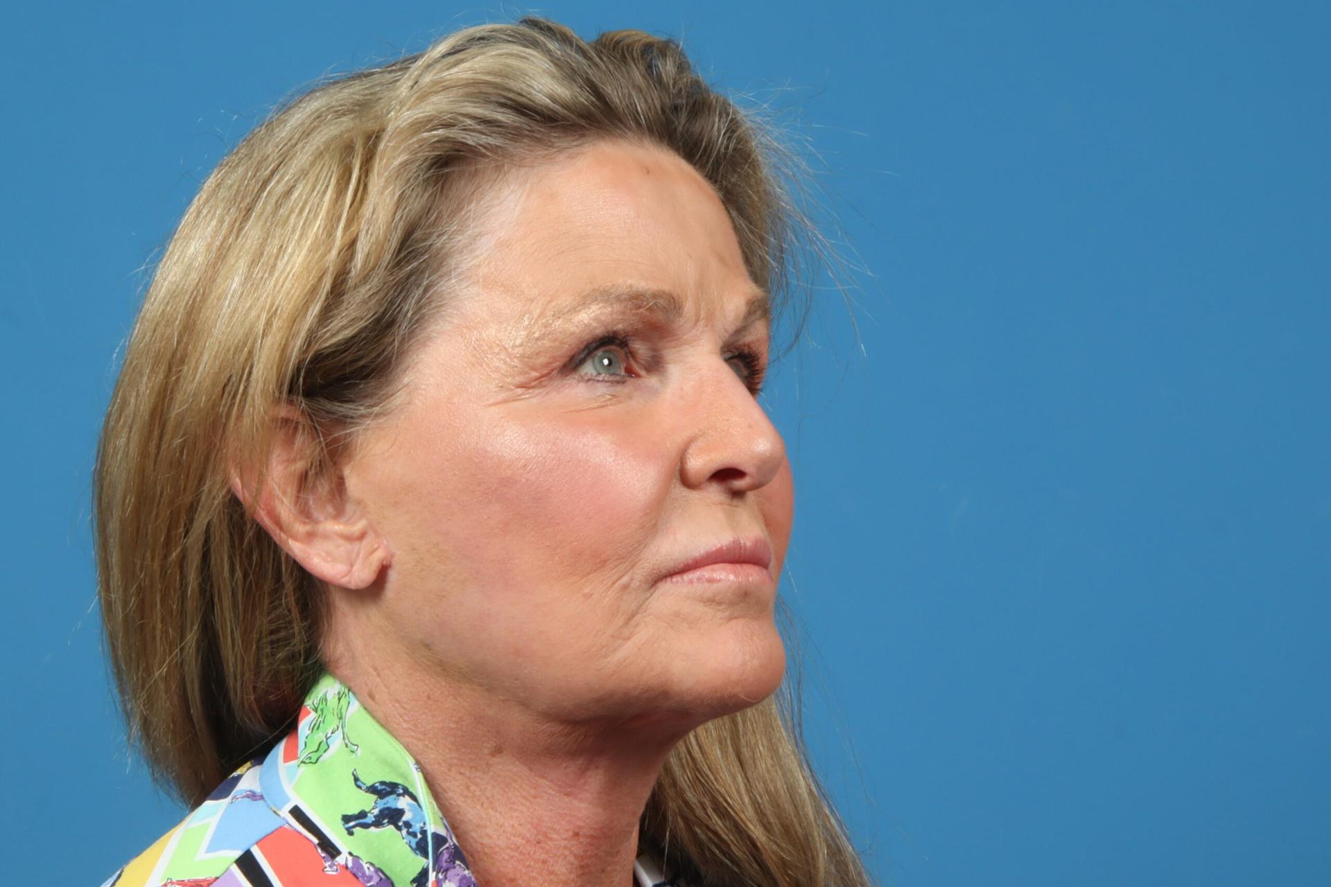 Plastic Surgery Associates facelift after — Grand Rapids, MI