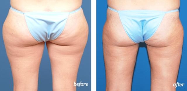 Liposuction result at Plastic Surgery Associates in Grand Rapids, MI
