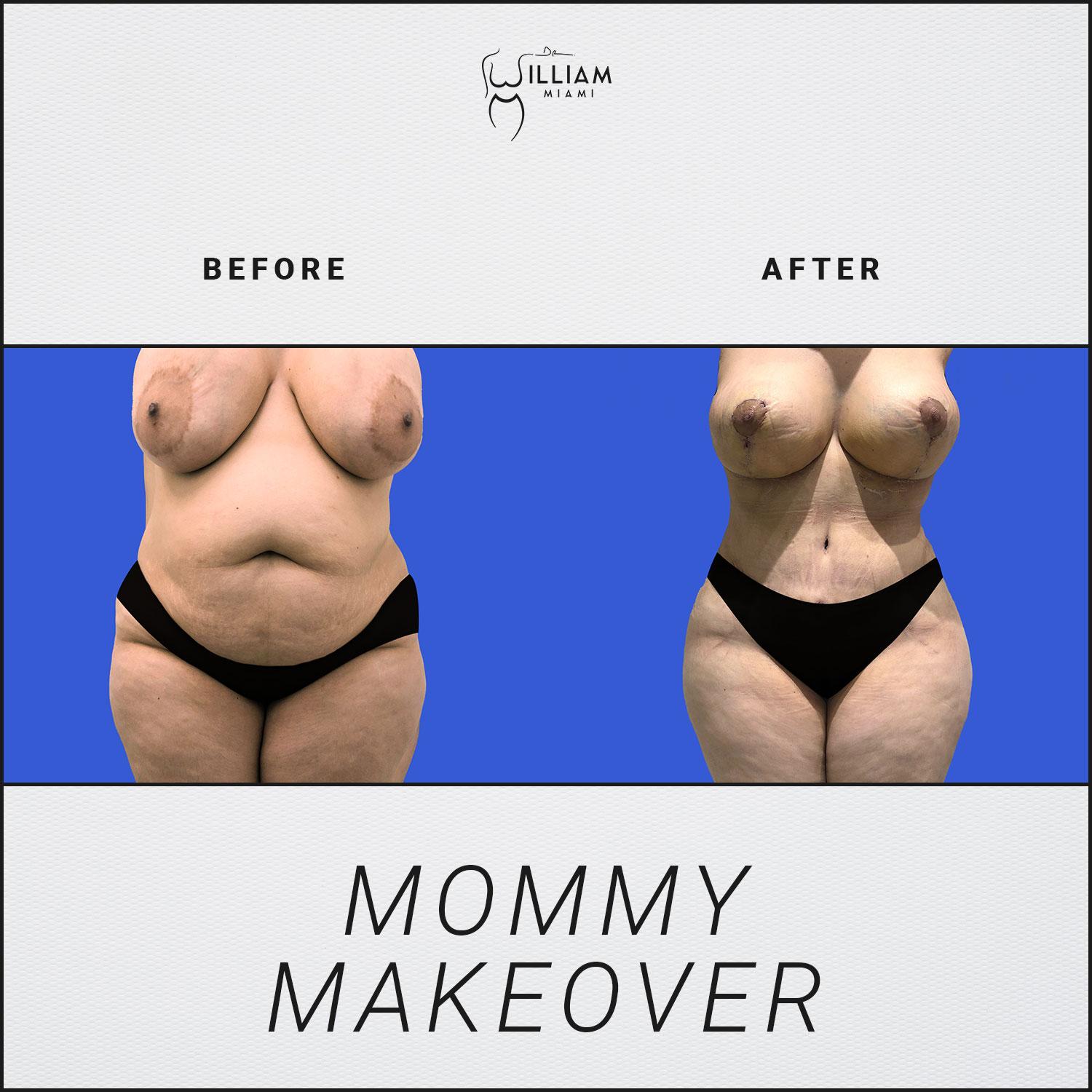 Dr. William Miami mommy makeover result — Miami, FL