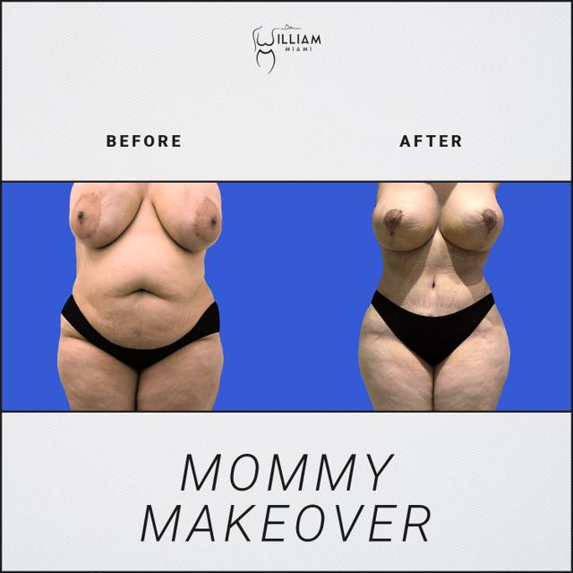 Mommy Makeover result at Dr. William Miami in Miami, FL