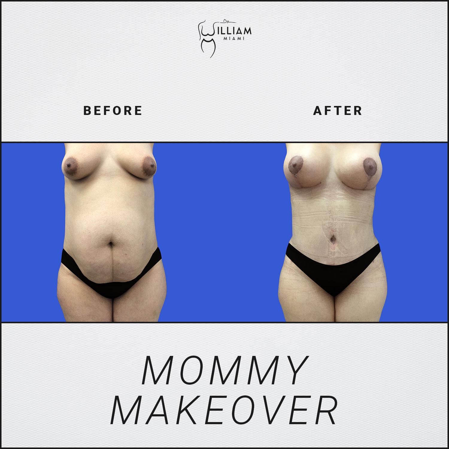 Dr. William Miami mommy makeover result — Miami, FL