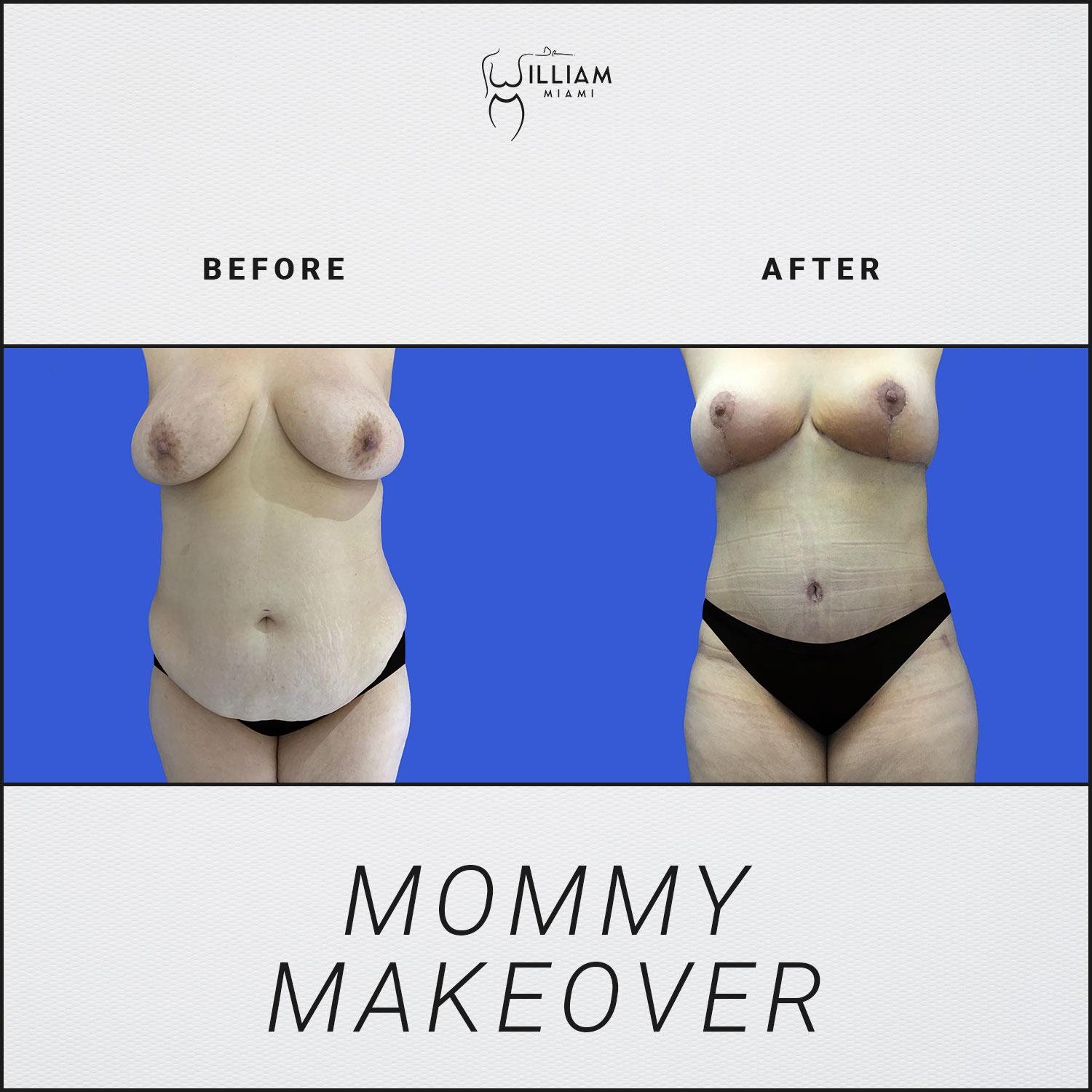 Dr. William Miami mommy makeover result — Miami, FL