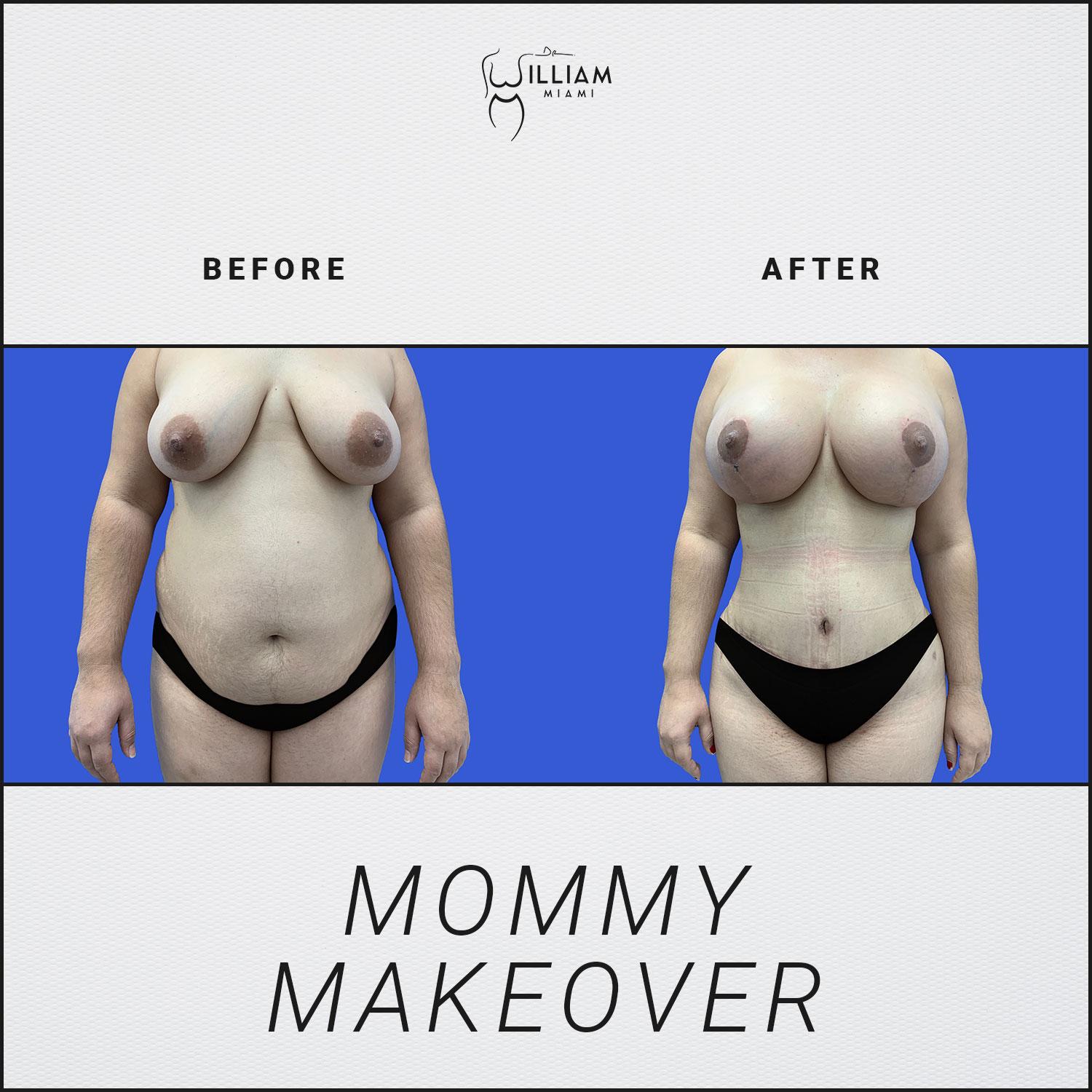 Dr. William Miami mommy makeover result — Miami, FL