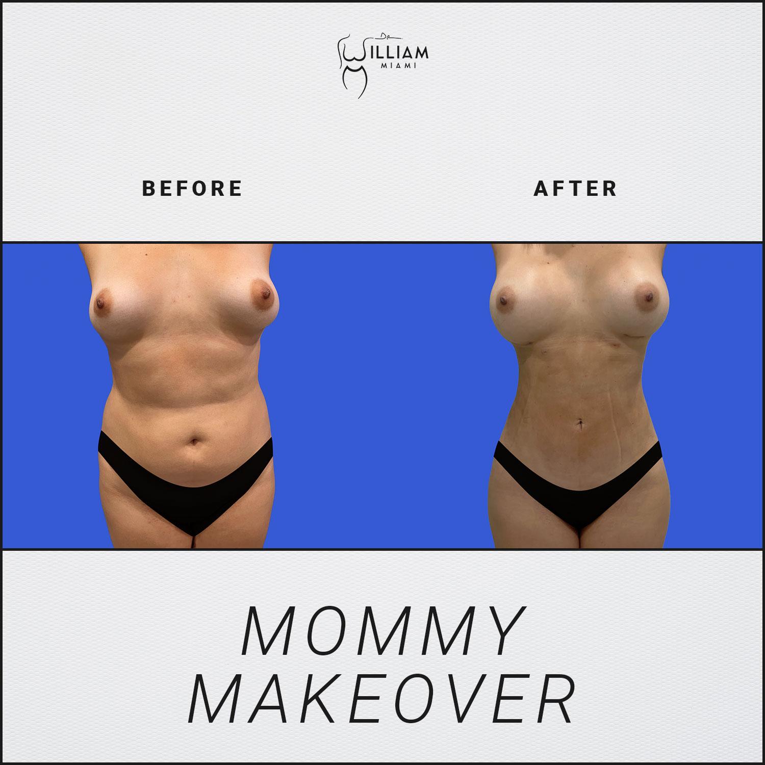 Dr. William Miami mommy makeover result — Miami, FL