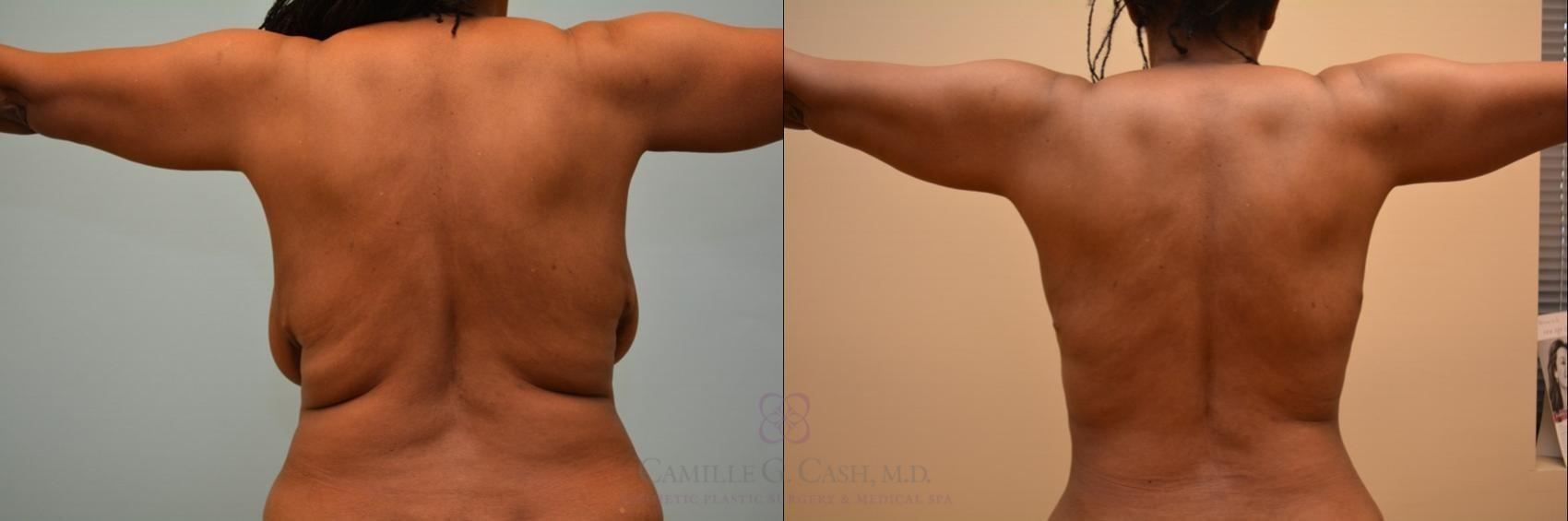Camille Cash, MD liposuction result — Houston, TX