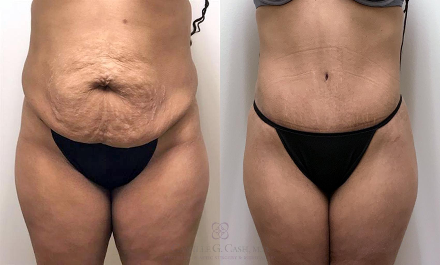 Camille Cash, MD tummy tuck result — Houston, TX