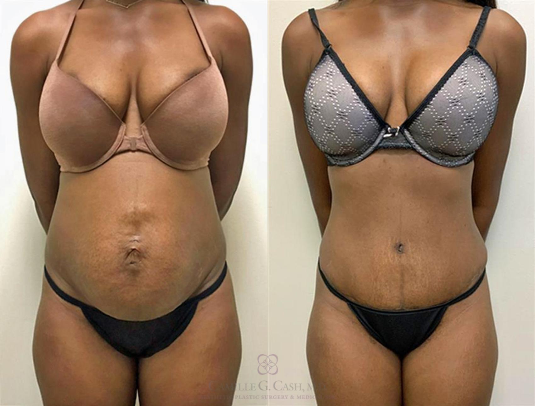 Camille Cash, MD tummy tuck result — Houston, TX