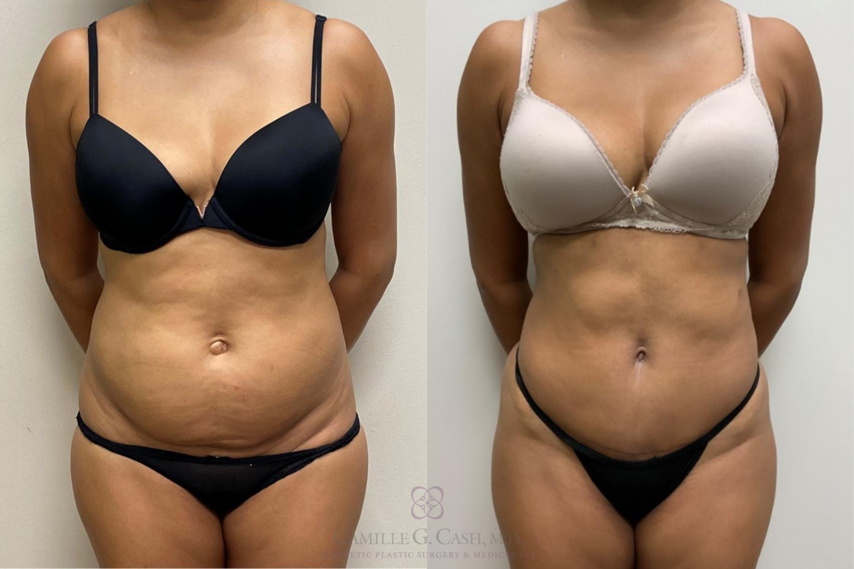 Camille Cash, MD tummy tuck result — Houston, TX