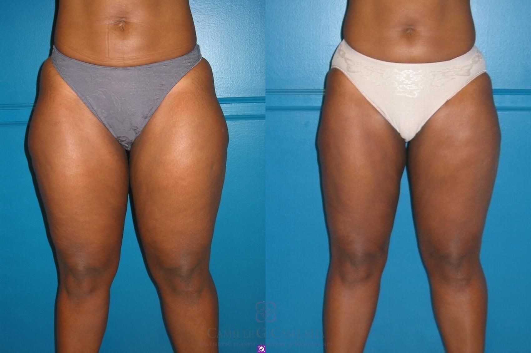 Camille Cash, MD liposuction result — Houston, TX