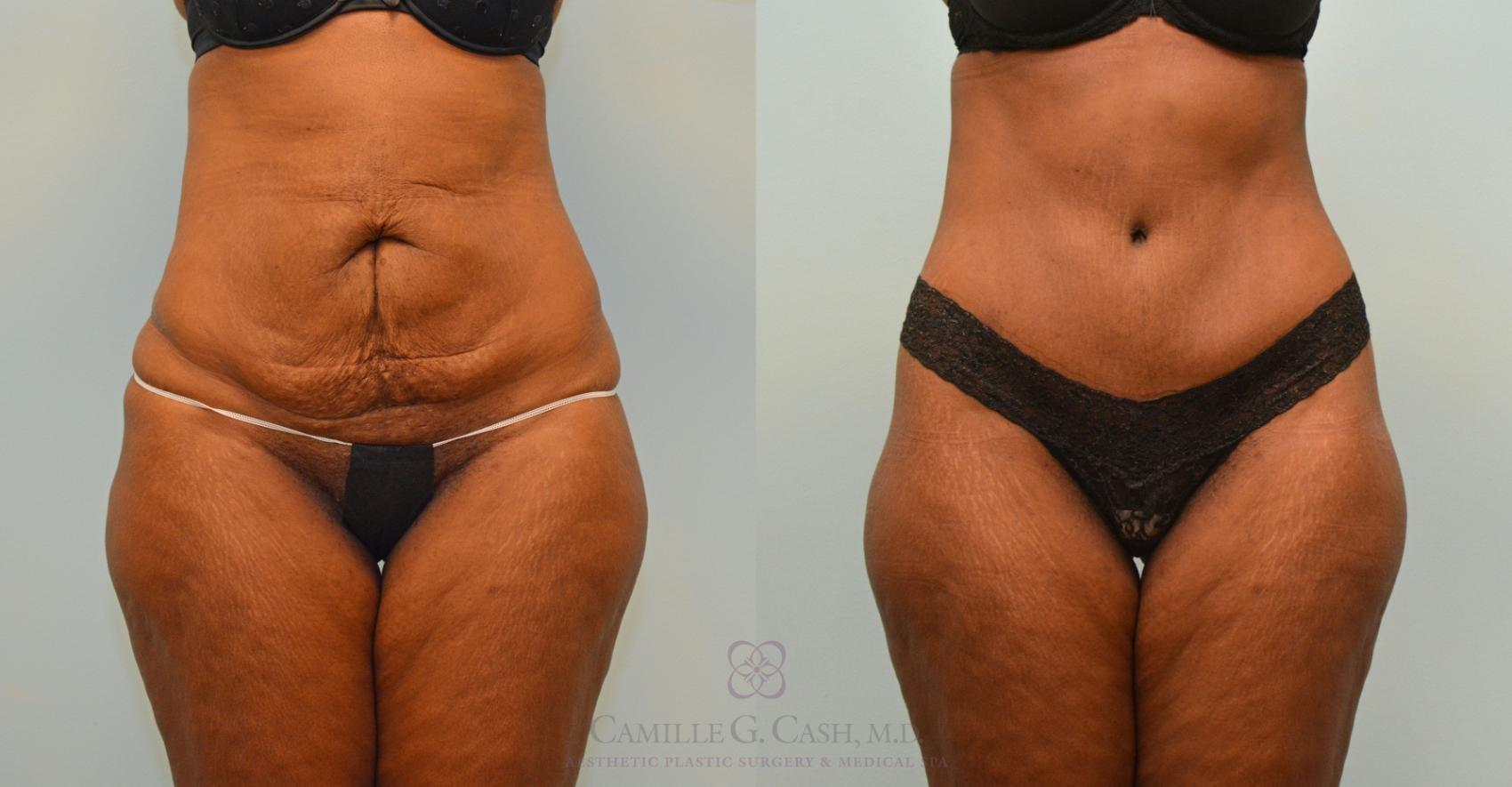 Camille Cash, MD tummy tuck result — Houston, TX