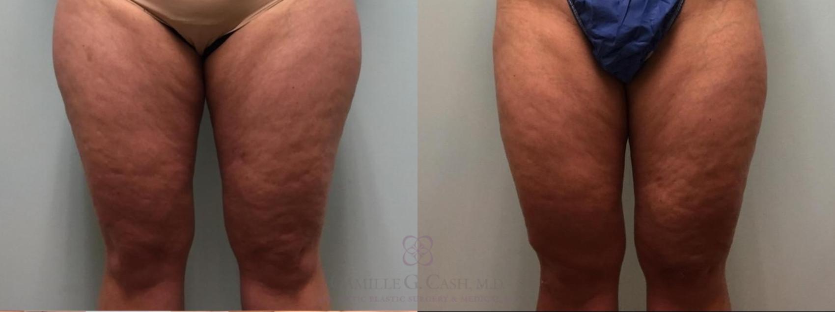 Camille Cash, MD liposuction result — Houston, TX