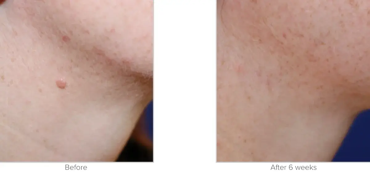Texas Facial Aesthetics result — Frisco, TX