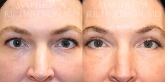Blepharoplasty result at Texas Facial Aesthetics in Frisco, TX