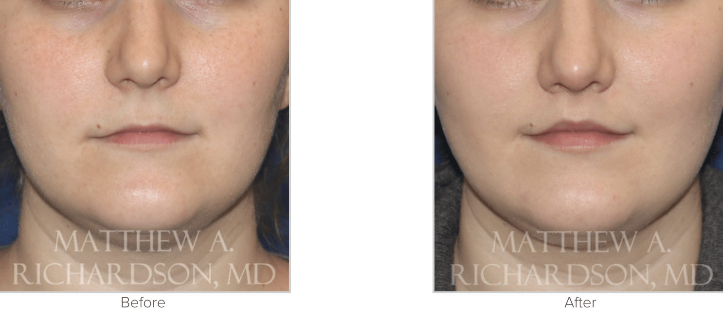 Texas Facial Aesthetics result — Frisco, TX