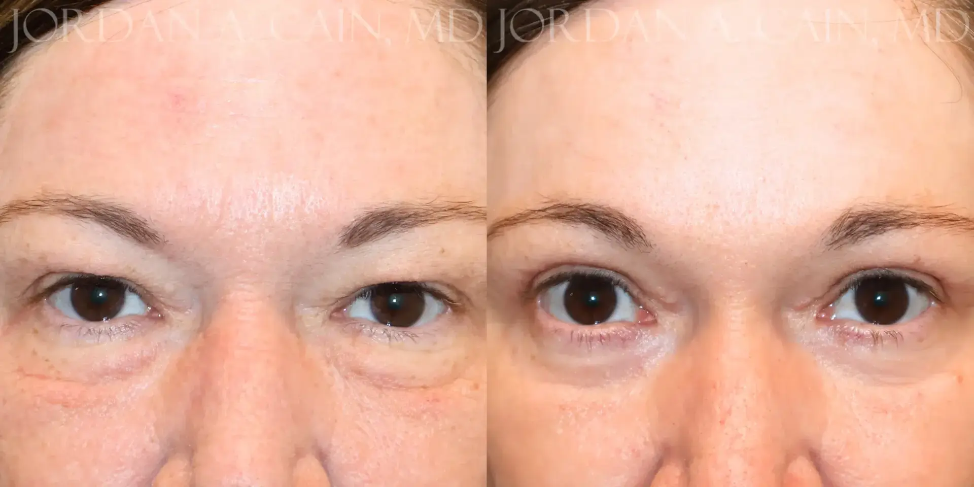 Texas Facial Aesthetics result — Frisco, TX