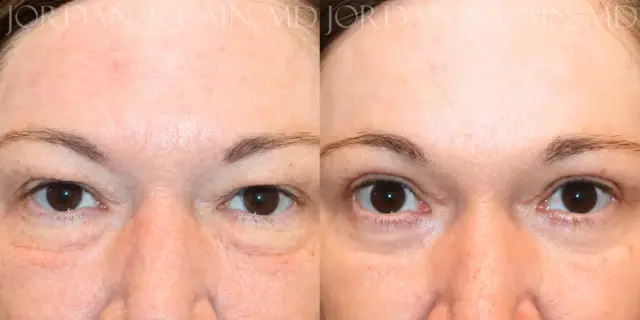 Blepharoplasty result at Texas Facial Aesthetics in Frisco, TX