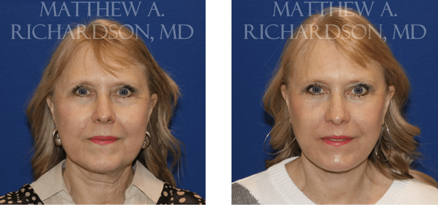 Neck Lift result at Texas Facial Aesthetics in Frisco, TX