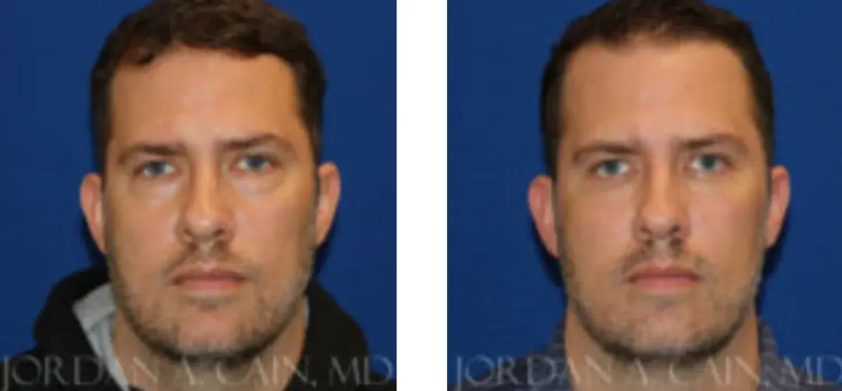 Texas Facial Aesthetics result — Frisco, TX