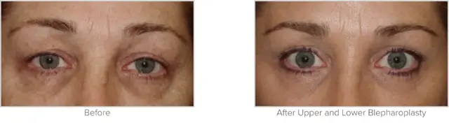 Blepharoplasty result at Texas Facial Aesthetics in Frisco, TX
