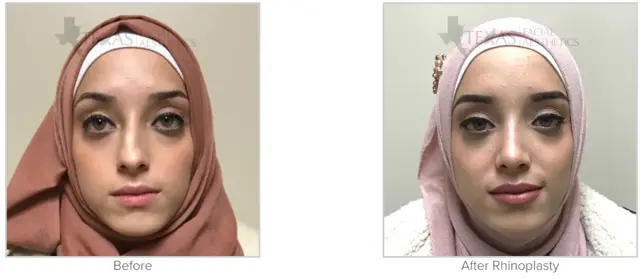 Revision Rhinoplasty result at Texas Facial Aesthetics in Frisco, TX
