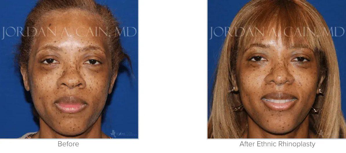 Texas Facial Aesthetics result — Frisco, TX