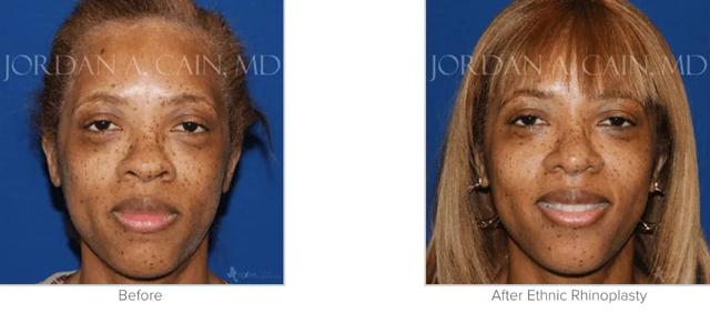 Revision Rhinoplasty result at Texas Facial Aesthetics in Frisco, TX