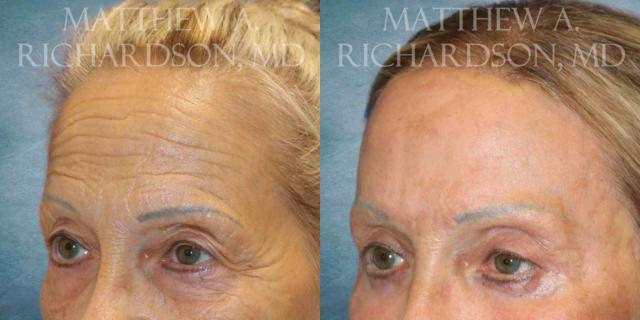 Brow Lift result at Texas Facial Aesthetics in Frisco, TX