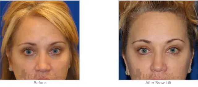 Brow Lift result at Texas Facial Aesthetics in Frisco, TX