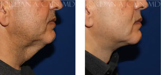 Neck Lift result at Texas Facial Aesthetics in Frisco, TX