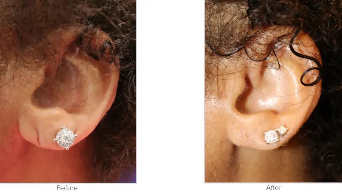 Texas Facial Aesthetics result — Frisco, TX