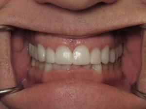 Dean Cosmetic Dentistry smile makeover after — Knoxville, TN
